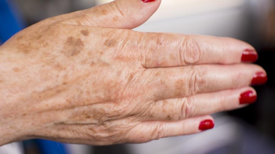 Se as manchinhas nas mãos te incomodam, alguns tratamentos podem ser eficazes para diminui-las - iStock