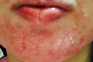 dieta alcalina per rosacea dieta alcalina per rosacea