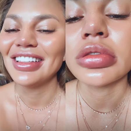 Chrissy Teigen mostrou os lábios inchados no Instagram - Reprodução / Instagram