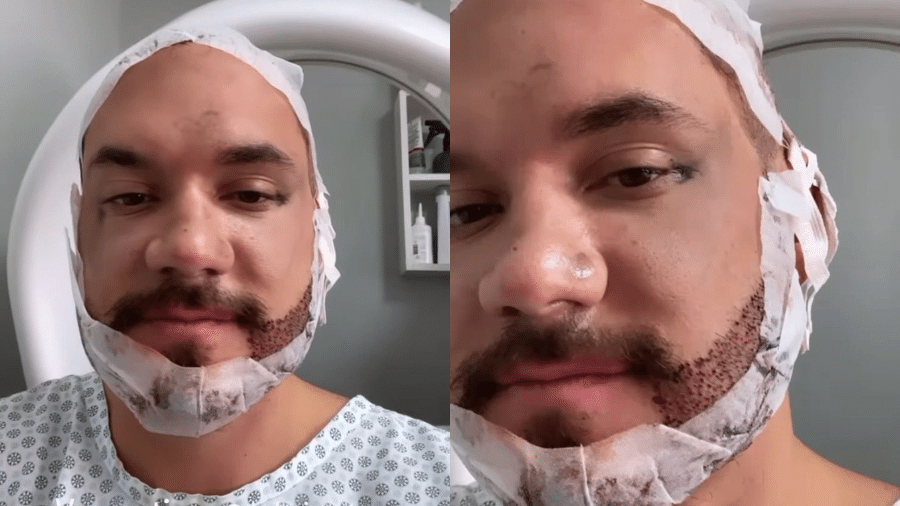 Eliezer fez uma cirurgia para preenchimento de barba e cabelo - Reprodução/Instagram