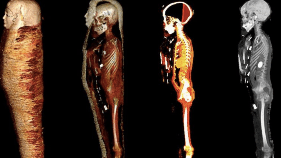 Uma equipe de pesquisadores egípcios usou um tomógrafo para examinar uma múmia de 2.300 anos que estava armazenada no Museu do Cairo por mais de um século - Cortesia S.N. Saleem, S.A. Seddik, M. El-Halwagy