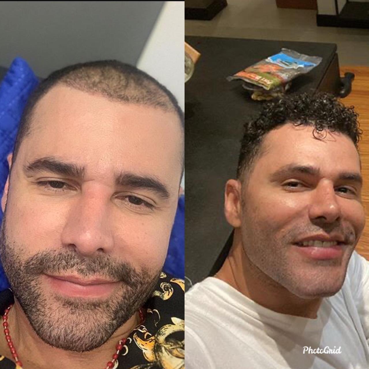 Rodrigo Santana Antes E Depois