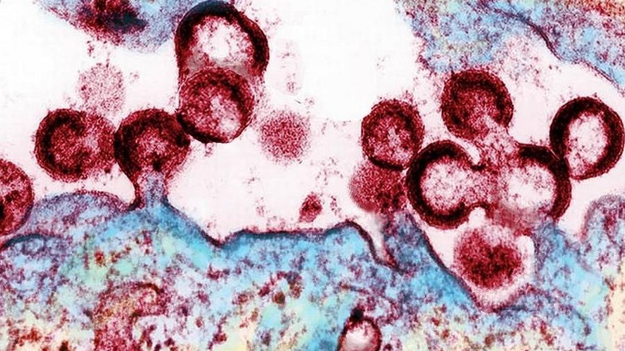 Amostra de células humanas infectadas pelo HIV - NIAID-NIH