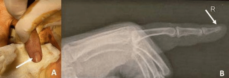 Mulher com tumor raro no dedo - Divulgação/ Clínica Wigmore e Hospital Civil de Lyon - Divulgação/ Clínica Wigmore e Hospital Civil de Lyon