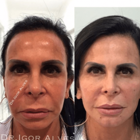 Gretchen passa por harmonização facial e mostra antes e depois - Reprodução/Instagram