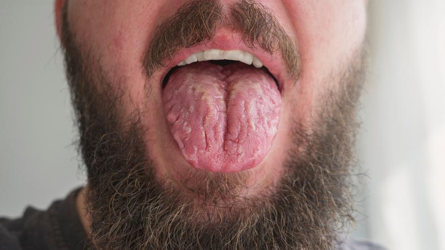 Bactérias da boca estão ligadas a problemas de saúde graves que ocorrem em outras partes do corpo