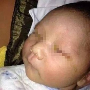 O bebê teve redução parcial de visão em um olho e perda total da vista no outro - People"s Daily/Reprodução