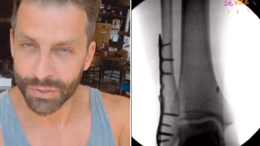 Henri Castelli diz que ficou de fora da "Dança dos Famosos" para se recuperar de uma fratura no tornozelo - Reprodução/Instagram