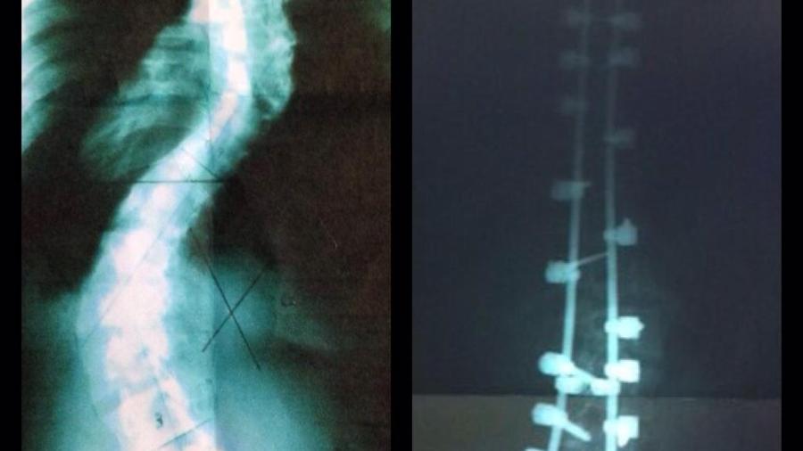À esq.: raio-X da coluna em S de Bruna Faro, diagnosticada com escoliose idiopática severa; à dir.: vê-se pinos e hastes de titânio na coluna - Arquivo pessoal
