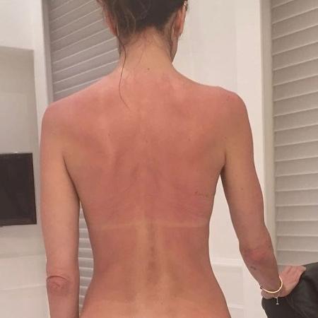Luciana Gimenez no Instagram mostra costas queimadas pelo sol - Reprodução/instagram.com/lucianagimenez/