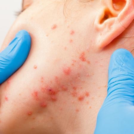 Crise de acne pode surgir em diferentes graus - iStock - iStock