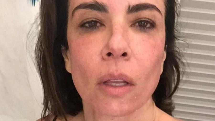 Luciana Gimenez mostra rosto após tratamento com aparelho Dermaroller - Reprodução/Instagram