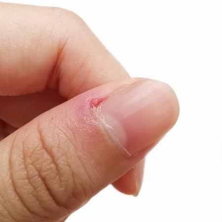 Unha cutícula inflamada - iStock - iStock
