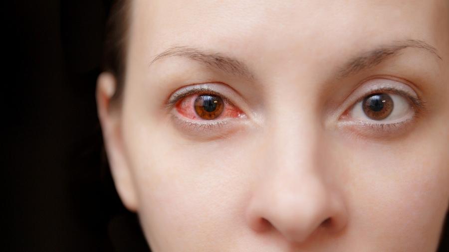 Os olhos podem ficar mais irritados graças à fuligem das queimadas e ao tempo seco