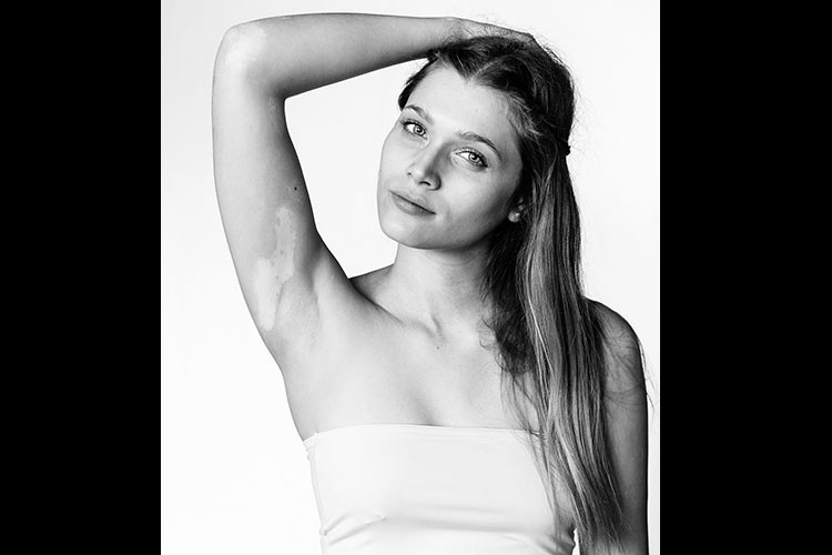 Modelos com vitiligo - Divulgação/Julia Kaczorowska