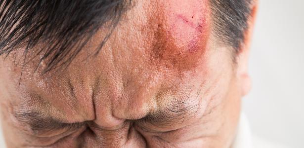 Pancada na Cabeça: Veja Riscos, Sintomas e O Que Fazer