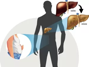 Gordura no figado: conheça sintomas e tratamento contra esteatose hepática
