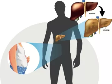 Gordura no fígado virou problema frequente: conheça sintomas e o tratamento