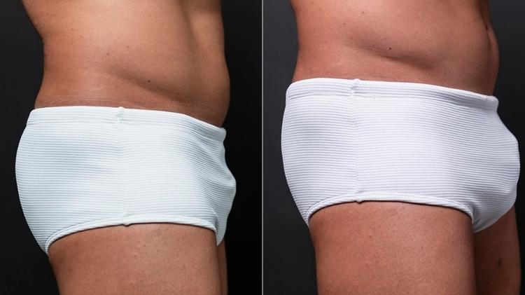 Antes e depois da harmonização peniana de Bruno