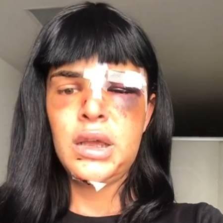 Alice Felis teve o nariz e o maxilar quebrados em virtude da agressão - Reprodução/Instagram