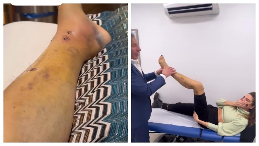 Luciana Gimenez mostrou hematomas e pontos na perna esquerda após acidente - Reprodução