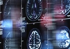 Chinês de 19 anos pode ser pessoa mais jovem com Alzheimer e causa é mistério para cientistas - Getty Images