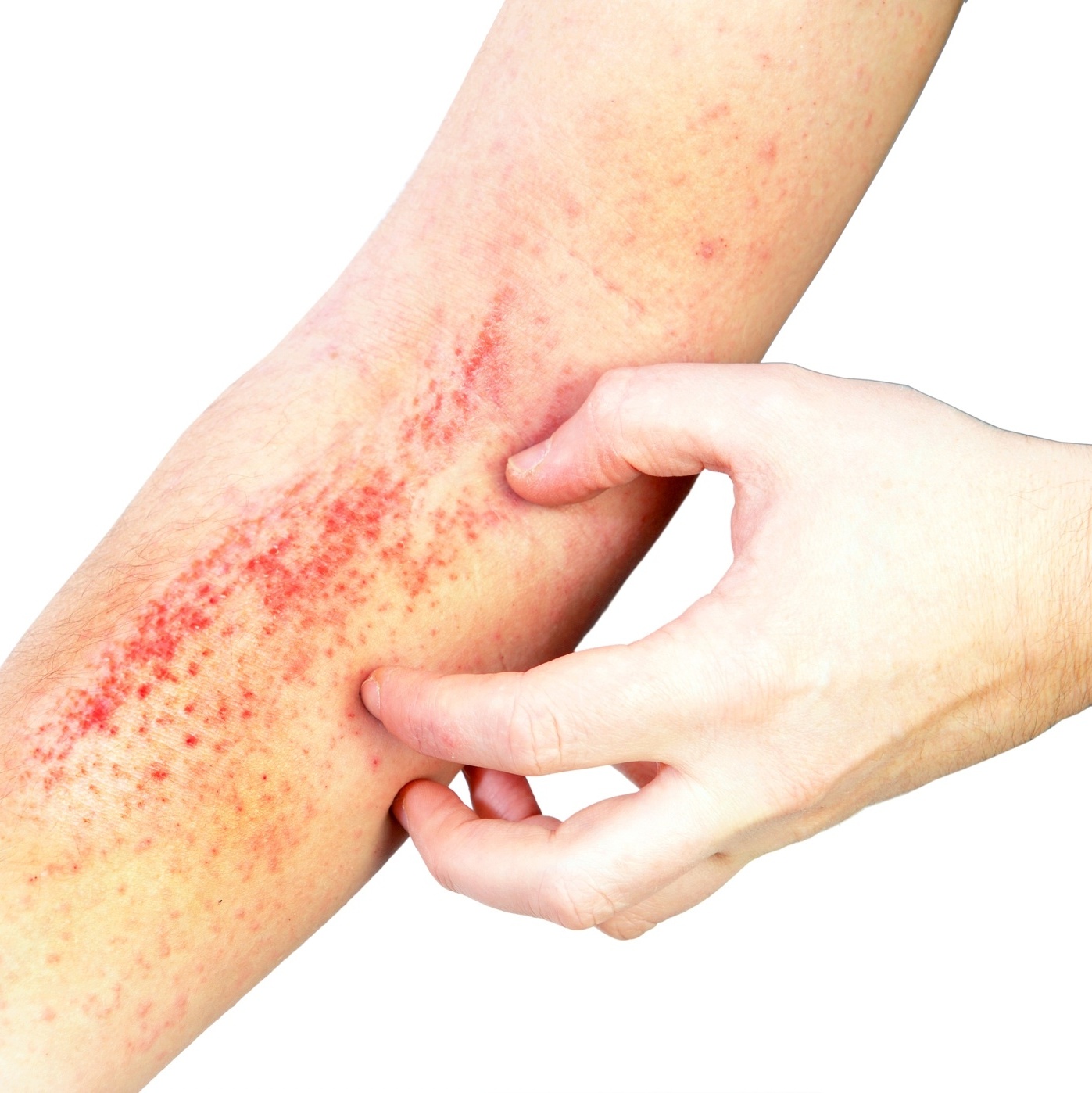 8 Causas de manchas vermelhas na pele que coçam - Clínica Médica I