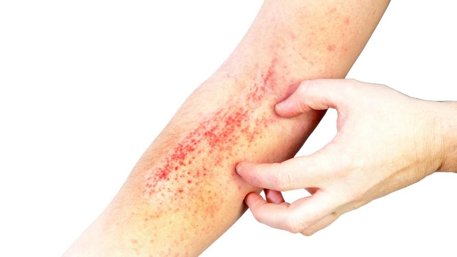 Entenda as principais causas de mancha vermelha na pele e tratamento - iStock