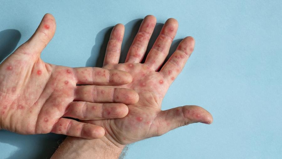monkeypox, varíola dos macacos, lesões nas mãos,  - iStock
