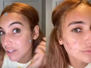 Vanessa Lopes exibe resultados de tratamento contra acne: 'Dá certo'