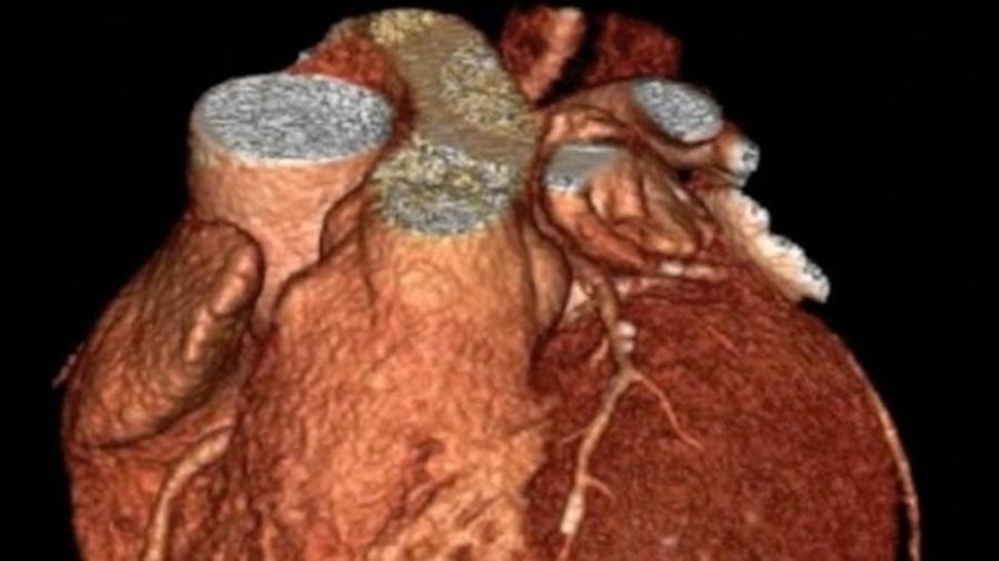 Cientistas identificaram gene que deixa os seres humanos predispostos a ter problemas cardíacos. A imagem é de um coração humano visto em scan cardíaco - Michelle Williams, University of Edinburgh/ Co