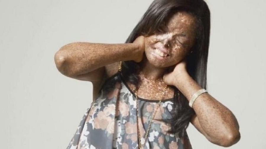 A dona de casa Juliana Flores, 30 anos, foi diagnosticada com uma doença rara chamada xeroderma pigmentoso - Arquivo pessoal