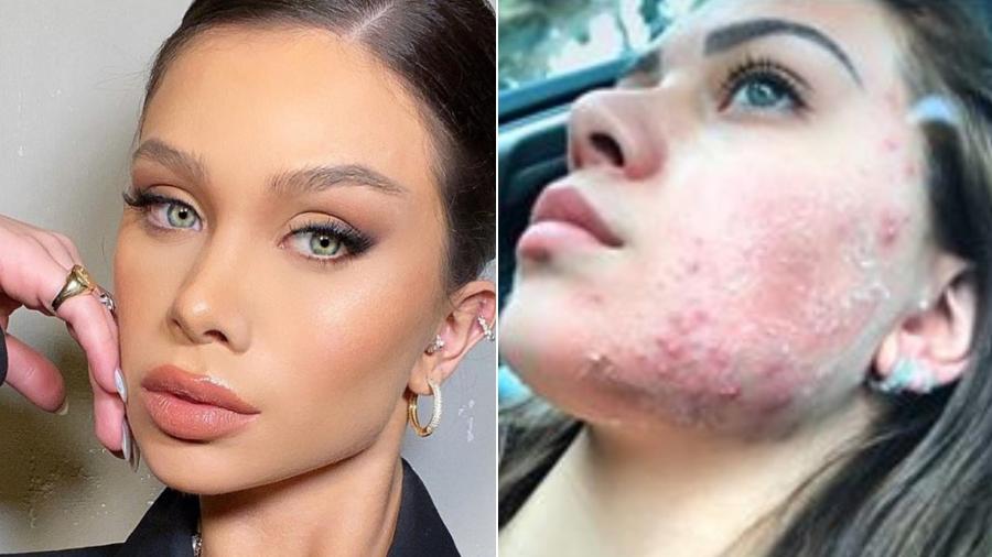 Flávia Pavanelli mostrou nas redes sociais como estava sua pele antes de tratamento para acne - Reprodução/Instagram