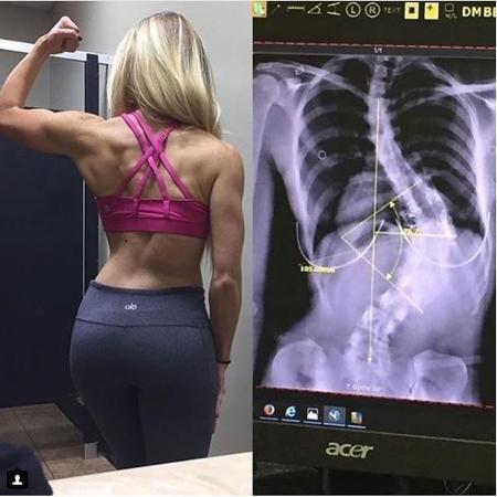 Mesmo com médicos apontando riscos para seu coração e pulmão, blogueira fitness com escoliose decidiu não operar a coluna - Reprodução/ Instagram