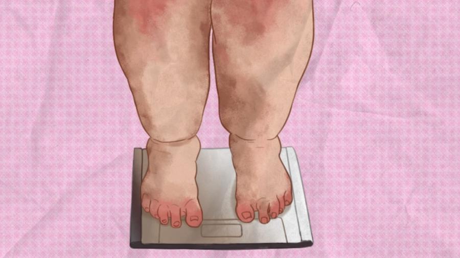 Pesquisadores mapearam a sola dos pés de mulheres com obesidade mórbida e não obesas - Guilherme Castro/Jornal da USP