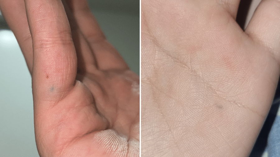Pessoas no Twitter compartilharam fotos de pontas de lápis presas à pele - Reprodução/Twitter