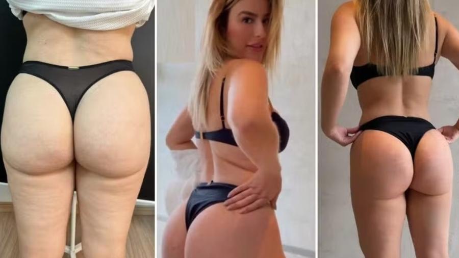 Fernanda Keulla mostra resultado de procedimento no bumbum