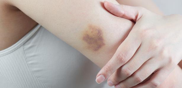 Manchas roxas no corpo: 8 possíveis causas e quando é grave