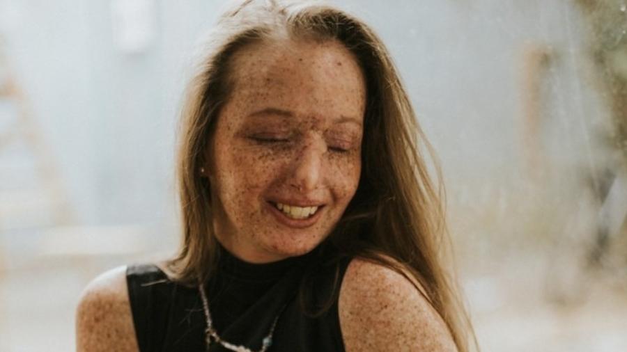 Sara do Nascimento, de 23 anos, foi diagnosticada com xeroderma pigmentoso