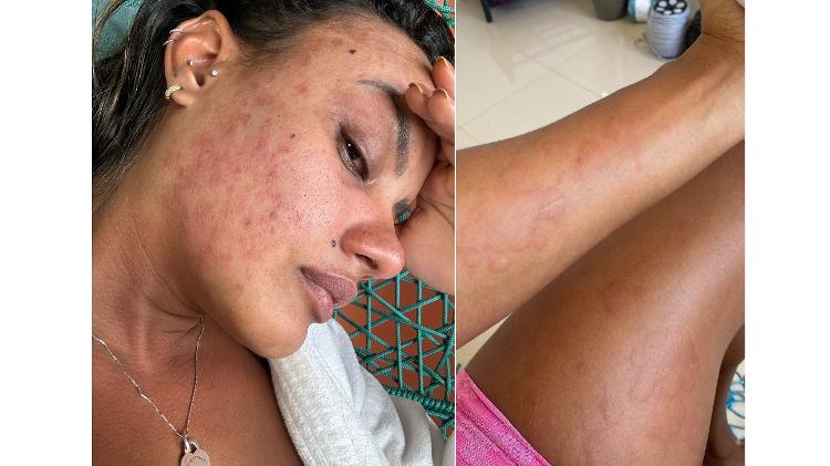 Eduarda viveu meses de terror quando viu manchas se espalharem pelo seu rosto e corpo sem que nenhum médico conseguisse identificar seu problema.