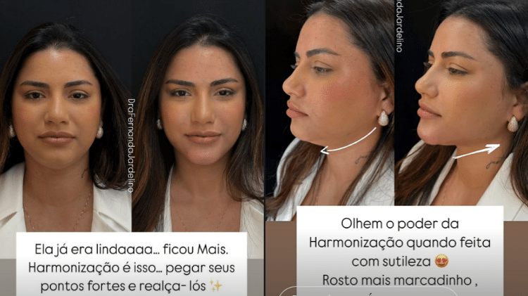 Médica mostra antes e depois de Távila Gomes, namorada de Luva de Pedreiro