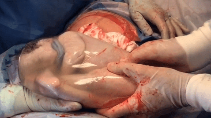 O médico Rodrigo da Rosa Filho, que conduziu o parto, compartilhou imagens dos bebês "empelicados" - Reprodução/Instagram
