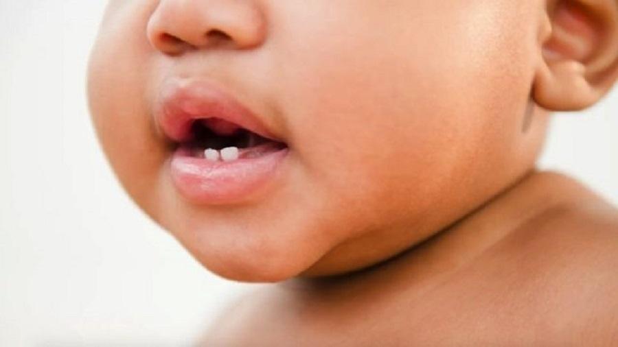 A língua presa é uma condição genética que vem recebendo mais atenção dos médicos e das famílias em todo o mundo - Getty Images