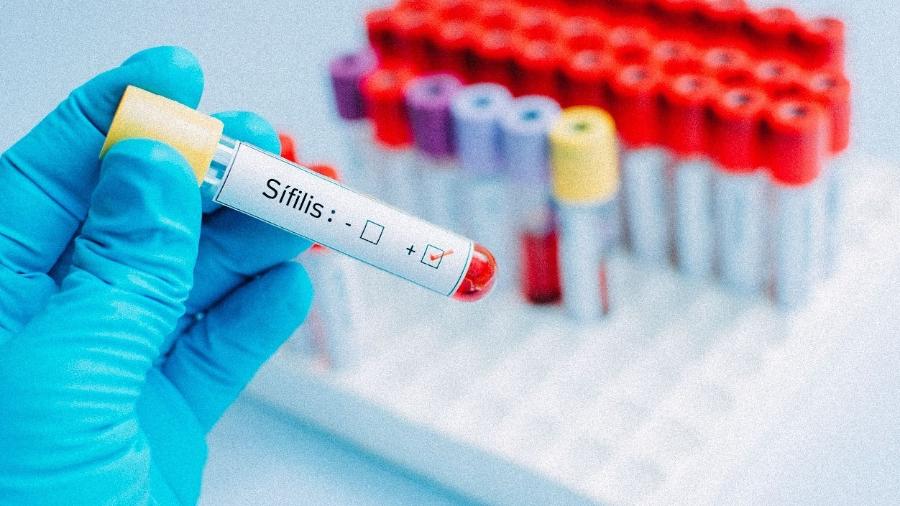 Foram notificados 158 mil casos de sífilis no Brasil em 2018 - Getty Images