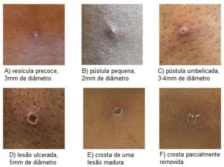 Imagens mostram evolução de lesões - Reprodução/Governo do Reino Unido - Reprodução/Governo do Reino Unido