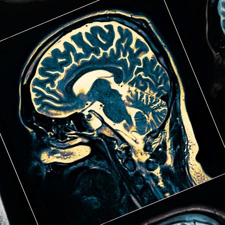Ressonância magnética de cérebro com Parkinson - iStock