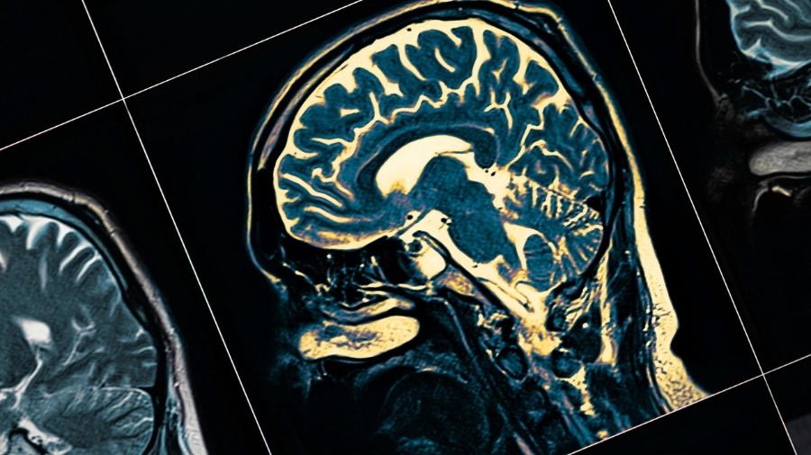 Ressonância magnética de cérebro com Parkinson - iStock