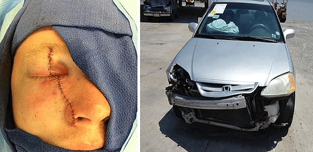 Corey Burdick, 26 anos, bateu seu Honda Civic 2001 na Flórida em maio de 2014; o ferimento, segundo seu advogado, aconteceu com a abertura do airbag da Takata - Reuters/Newsome Melton Law Firm