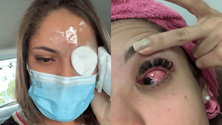 A estudante de odontologia Hellen Lyra, 21, contou que os primeiros sintomas ocorreram no olho direito - Arquivo pessoal