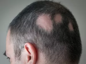 Alopecia areata: um remédio para homens e mulheres que perderam os cabelos